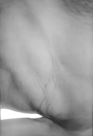 Foreign body XII